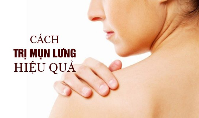 Cách trị mụn lưng hiệu quả