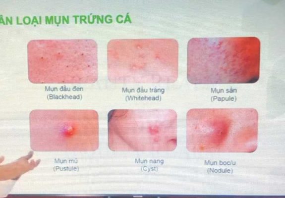 Các loại mụn