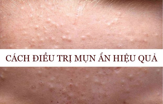 Cách trị mụn ẩn hiệu quả