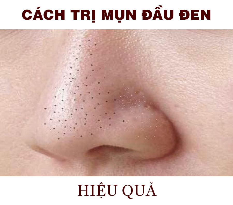 Cách trị mụn đầu đen hiệu quả