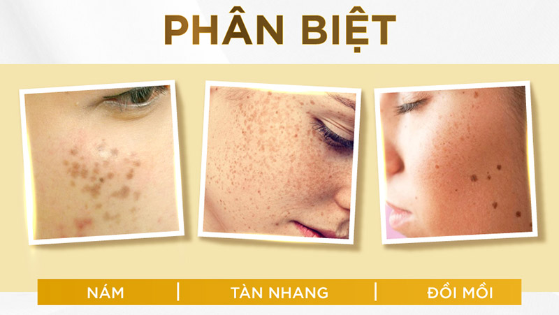 Phân loại tăng sắc tố da